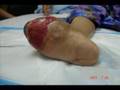 Diabetic Gangrene Case Diabetic Gangrene Case