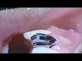 Porcelain Veneers Porcelain Veneers