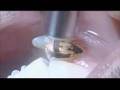 Porcelain Veneers