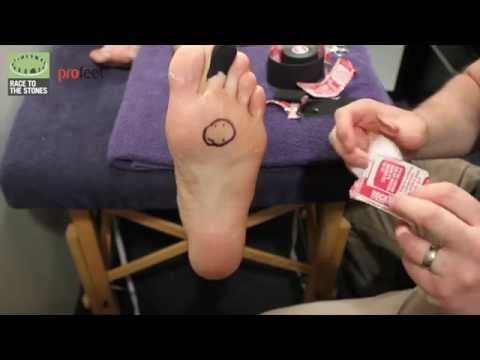 how to treat running blisters
