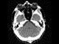 SART working on 240x240 CAT Scan