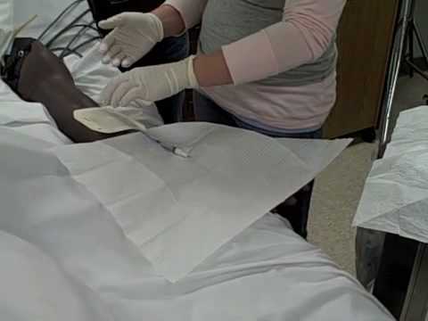 how to remove central line