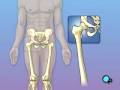 videos de Malpractice Medical Hip Replacement 1
