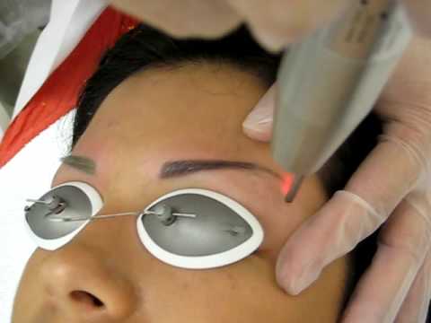Are you going to do eyebrow tattoo removal? And you miss the most expensive 