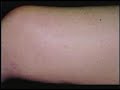 Treatment of Varicose and Spider Veins - Part 3