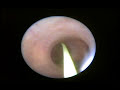Pedra no Rim - Calculo Renal Pedra no Rim - Calculo Renal