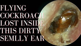 Flying COCKROACH Lost Inside This DIRTY SMELLY Ear