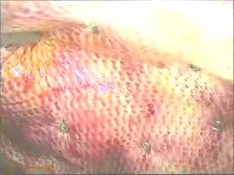 how to repair abdominal fascia