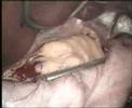 Sleeve Gastrectomy - Obesity Surgery