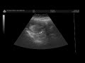 Bebé Tristán Yáñez de 12 Semanas de gestación Bebé Tristán Yáñez de 12 Semanas de gestación