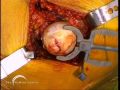 Birmingham Hip Resurfacing (BHR) by Derek McMinn Part 2