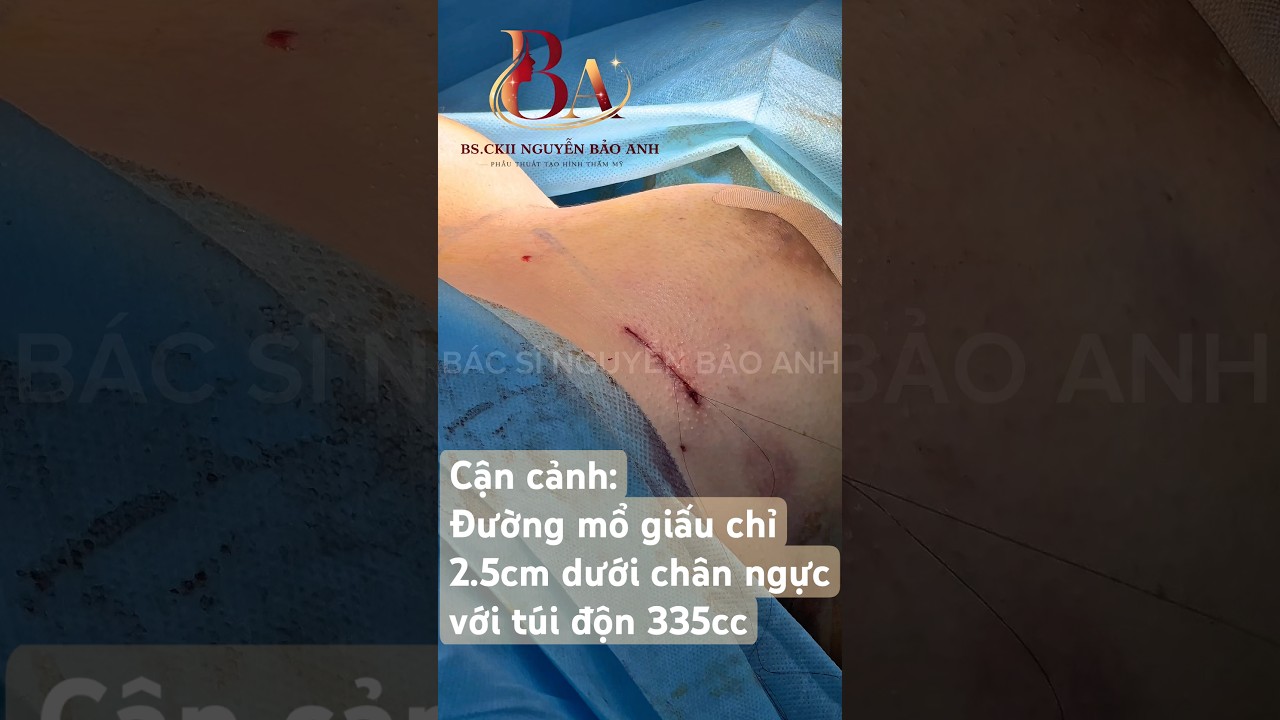 Cận cảnh: Đường mổ giấu chỉ 2.5cm dưới chân ngực với túi độn 335cc