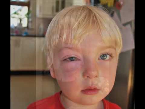 Anaphylaxis and Allergy Awareness | 100Faces Campaign
