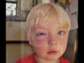 Anaphylaxis and Allergy Awareness | 100Faces Campaign
