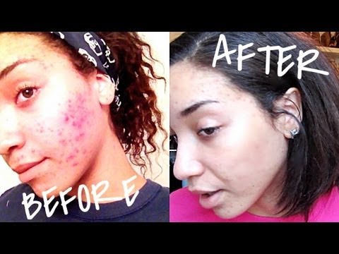 SKIN| Skin Care For Severe Acne