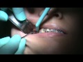 Zygomatic Buttress Y plate placement, part 1, incision and place contour
