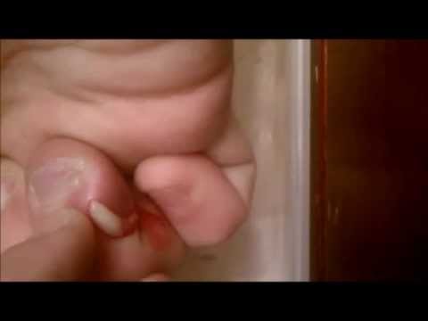 how to drain infected finger