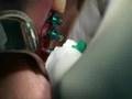 videos de Case 3 with Sinu-Lift System