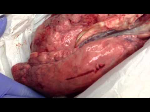 how to relieve pneumothorax