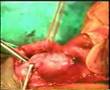 The Krishnamurti Operation for Peyronie's Disease (3 of 7)