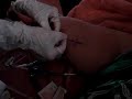 Becca's PICC Line Removal