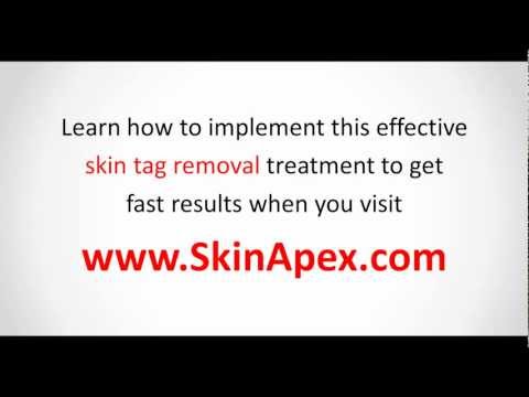 how to remove skin tags with compound w