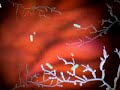 What is a Yeast Infection ?