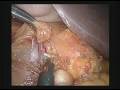 Laparoscopic left adrenalectomy (HD quality) Laparoscopic left adrenalectomy (HD quality)