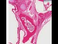 Histopathology Ovary--Benign teratoma