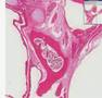 Histopathology Ovary--Benign teratoma