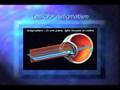 Dr. Maboudi talks about how the LASIK procedure is performed