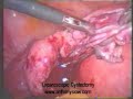 Laparoscopic Cystectomy