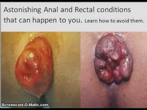 how to treat ileus