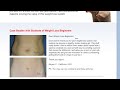 Weight Loss Before and After from Weight Loss Beginners Weight Loss Before and After from Weight Loss Beginners