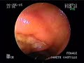 ENTERORRAGIA TIFICA Video del servicio de apoyo de gastroent