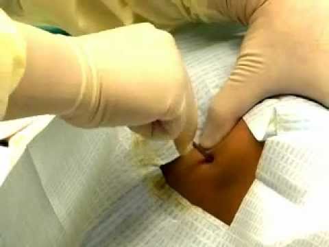 how to perform bone marrow biopsy