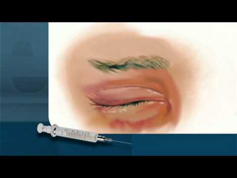 Botox Injections by Unlicensed Providers