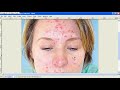 gimp tutorial 2.6 how to edit acne and blemishes