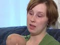 Conjoined Twins Separated in Womb