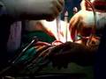 Live Webcast: Mitral Valve Repair Surgery