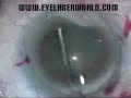 penetrating keratoplasty, keratoconus (2)