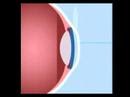 LASIK Basics - Quick Explaination of the LASIK Procedure