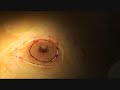 Abdominoplastia y Aumento De Mamas