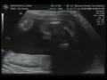 videos de Baby Rickels Ultrasound3