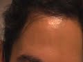The Acne Practice (Weaning off Antibiotics) The Acne Practice (Weaning off Antibiotics)