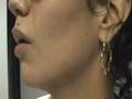 The Acne Practice (Weaning off Antibiotics)
