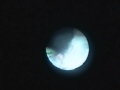 Recurrent Stenosis Of Ureteropelvic Junction - Ureteroscopic Laser Access Recurrent Stenosis Of Ureteropelvic Junction - Ureteroscopic Laser Access