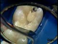 CeramX duo restauraci�n Clase II Dr P.Colon /2