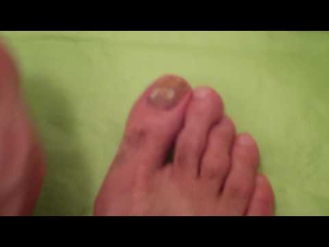 toenail
