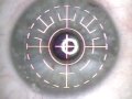 PRK Laser Eye Surgery PRK Laser Eye Surgery